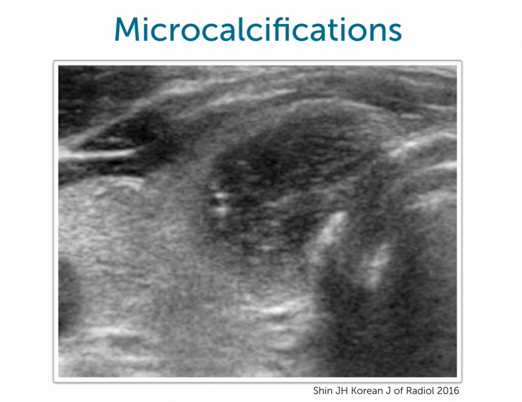 Thyroid Ultrasound: Microcalcifications.