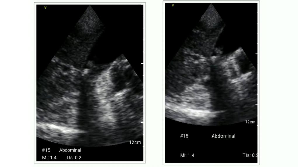2 Ultrasound images of abdominal ultrasound.