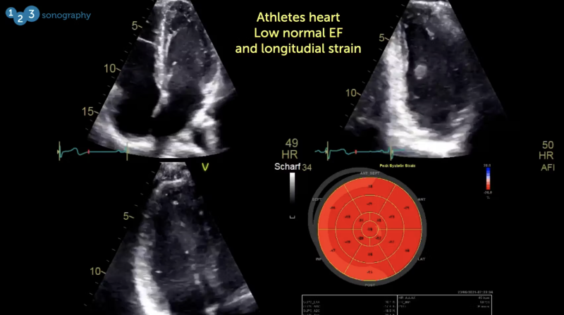 Thumbnail of Athletes heart echo loop