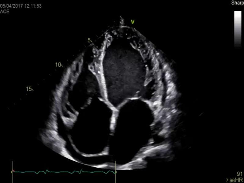 High-quality TTE image of severe LVF.