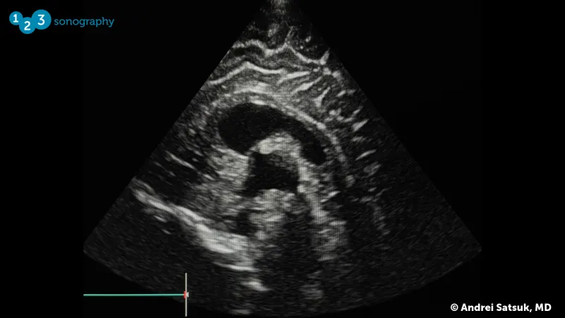 Neonatal Brain Ultrasound image, CSP and CV3.