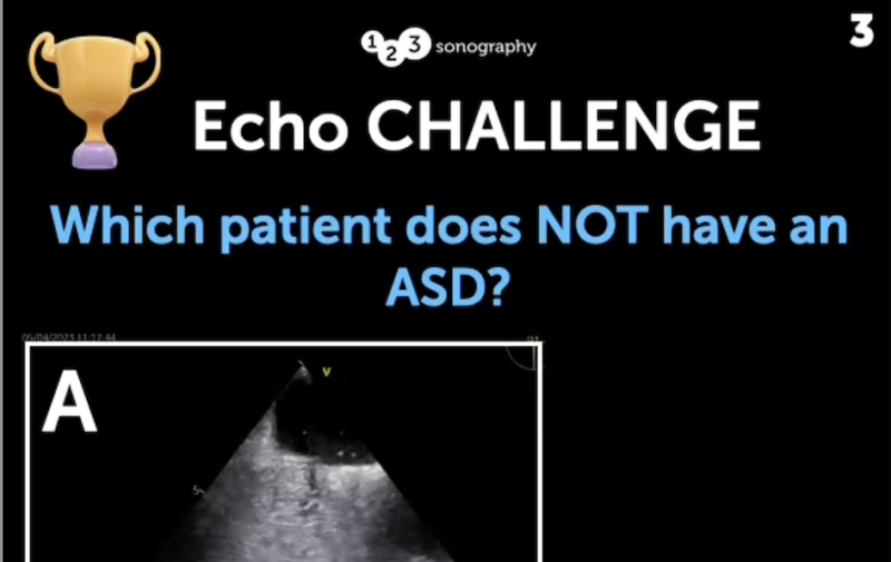 Echo Challenge: Which patient does not have ASD? Blog thumbnail.