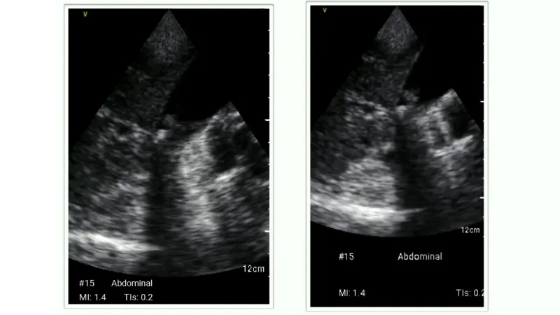 2 Ultrasound images of abdominal ultrasound.