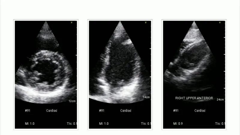 Echocardiogram of a 28-year-old patient.