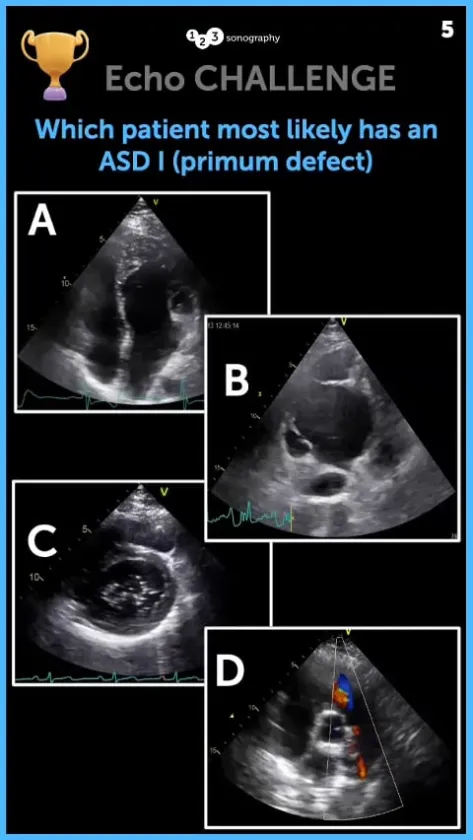 Echo Challenge: Which patient most likely has an ASD I (primum defect) Thumbnail.