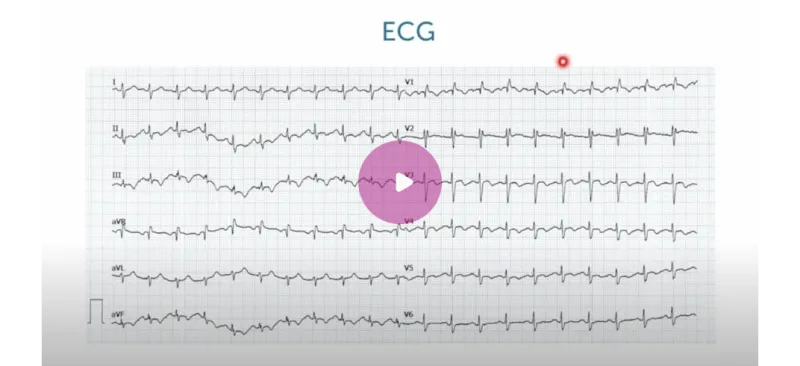ECG thumbnail.