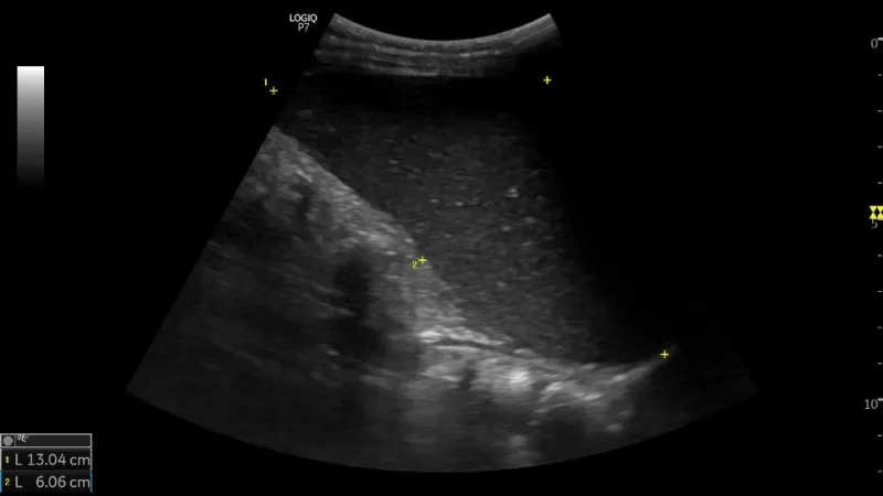 Ultrasound Image of Splenomegaly.