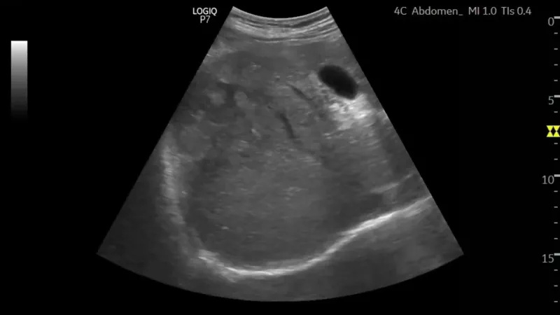 Liver transverse ultrasound image.