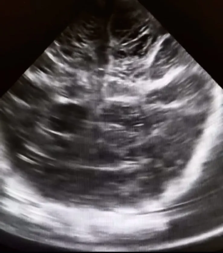Brain ultrasound image of a neonate.