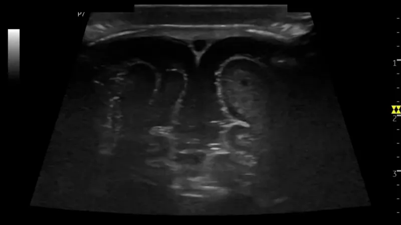 Ultrasound image of a neonatal brain ultrasound.