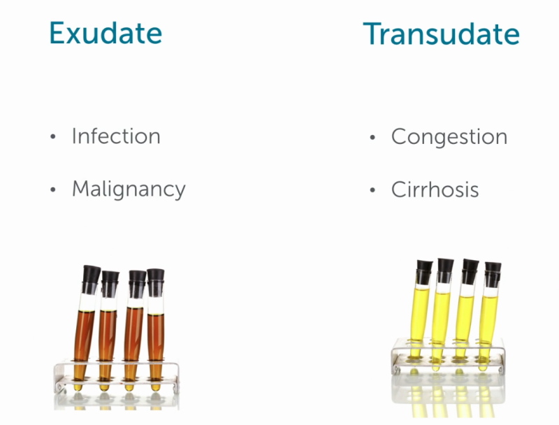 Pleural Effusion: Exudate vs Transudate.