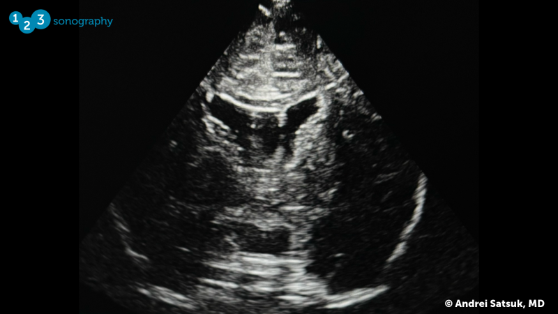 Neonatal Brain Ultrasound image, CSP and CV2.