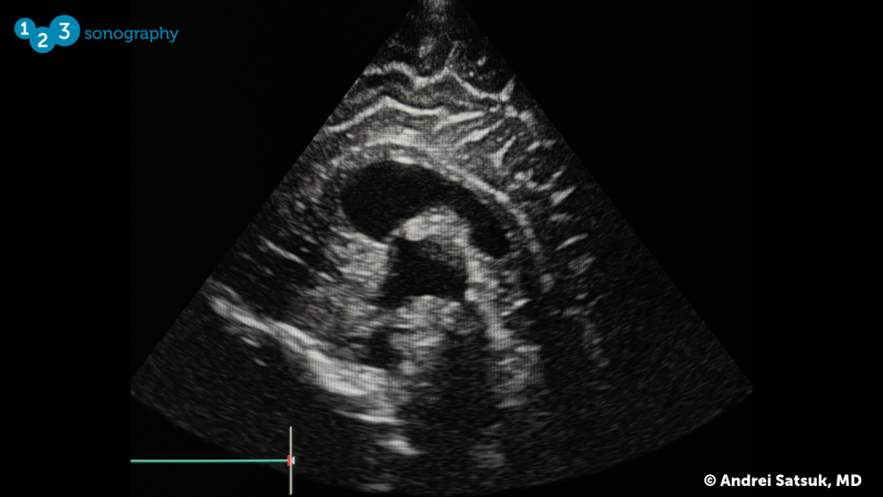 Neonatal Brain Ultrasound image, CSP and CV3.