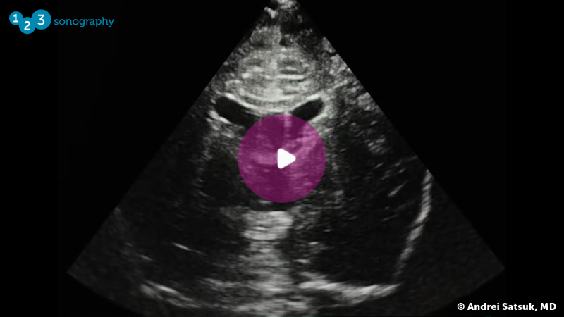 Neonatal Brain Ultrasound image with play button to start video.