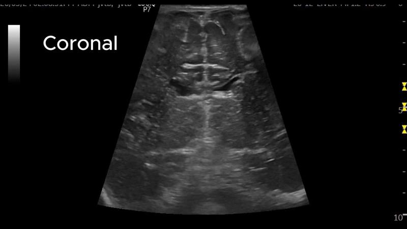 Choroid plexus cyst ultrasound image.