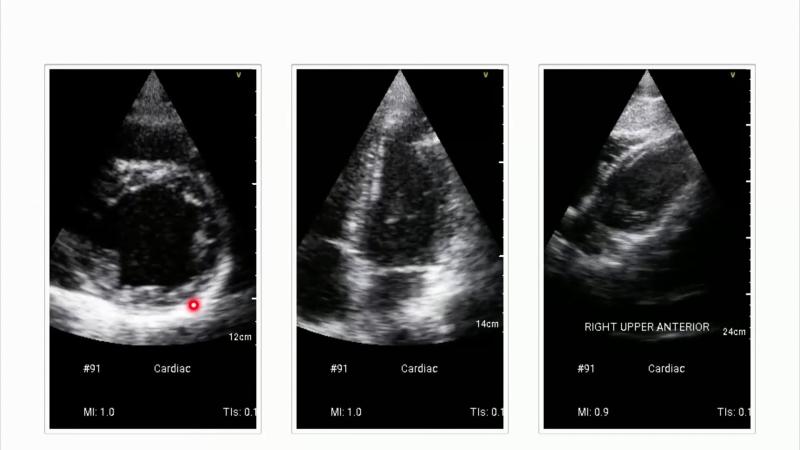 Echocardiogram of a 28-year-old patient with marker.