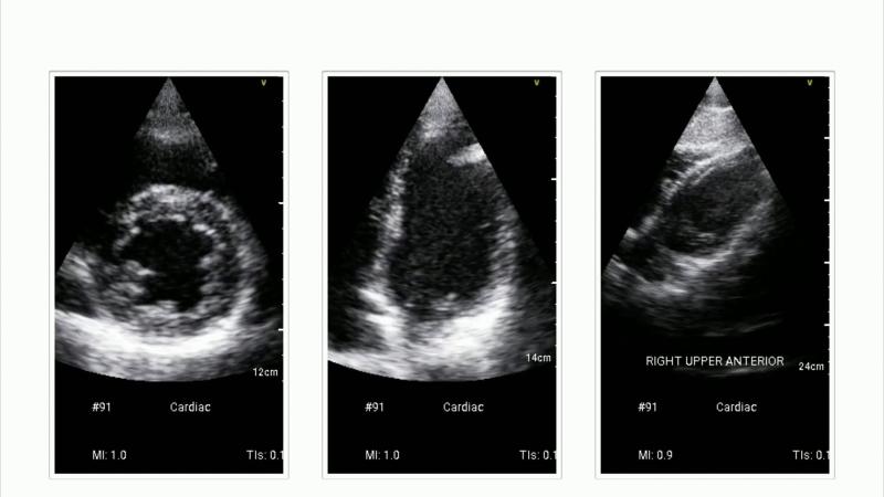Echocardiogram of a 28-year-old patient.