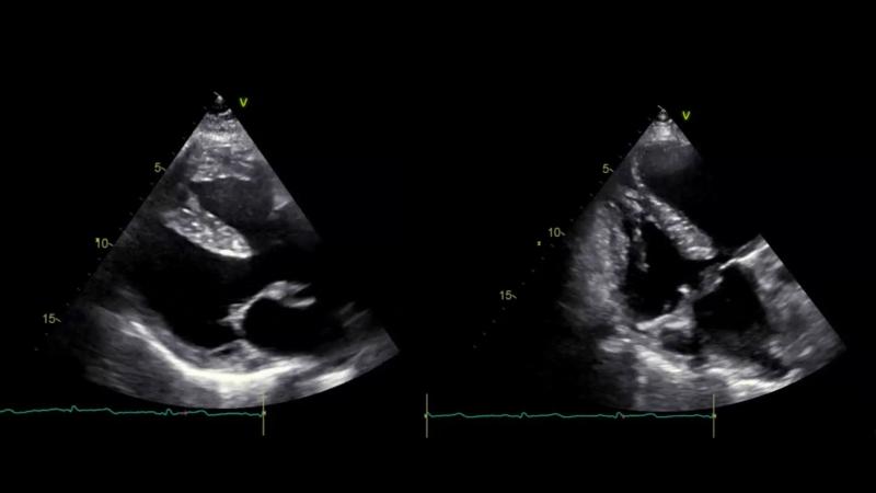 Thumbnail of Tetralogy of Fallot.