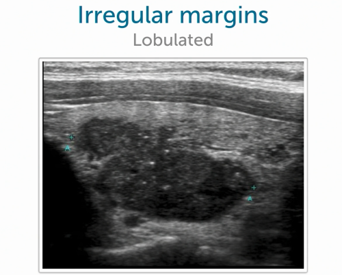 Thyroid Ultrasound: Irregular margins, lobulated.