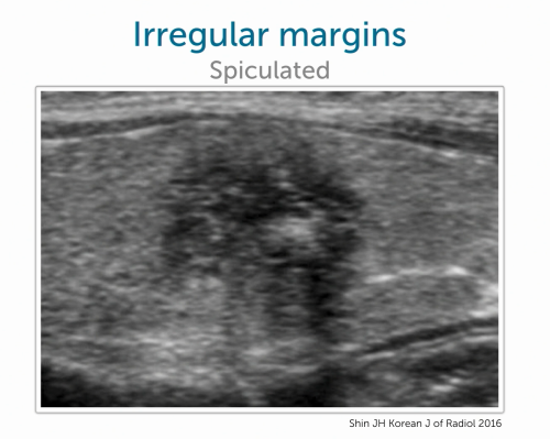 Thyroid Ultrasound: Irregular margins, spiculated.