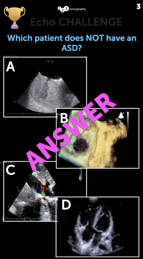 Echo Challenge: Which patient does not have ASD? Answer thumbnail.