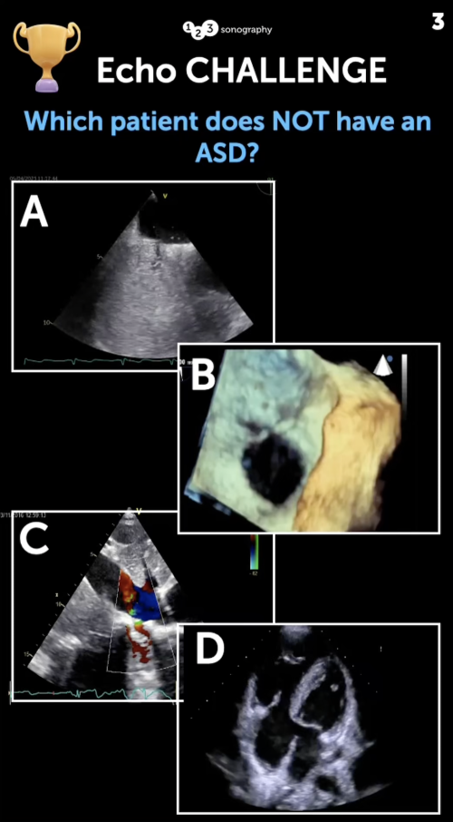 Echo Challenge: Which patient does not have ASD?