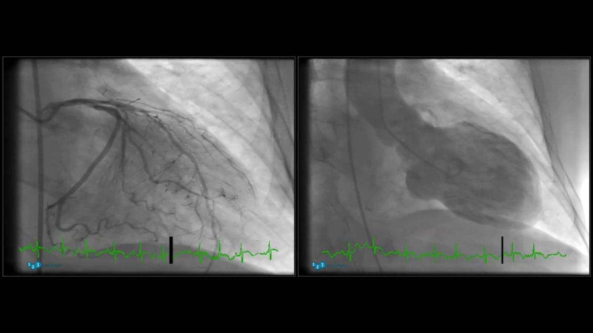 Takotsubo Angio Ventriculography thumbnail image.