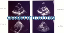 Heart Chamber Quantification MasterClass