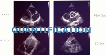 Heart Chamber Quantification MasterClass