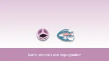 Aortic Valve Disease FocusClass