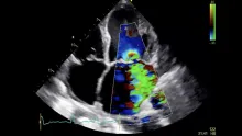 Mitral Regurgitation FocusClass