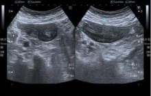 1- Transverse scan in the right lower quadrant 2 -Sagittal scan in the right lower quadrant