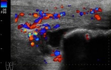 Longitudinal color doppler image of the right distal Achilles tendon