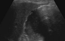 Longitudinal image of the gallbladder, patient is in supine position