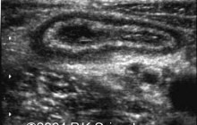 Transverse image of the right iliac fossa