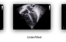 Ultrasound image of A4C in normal, underfilled, and overfilled state.