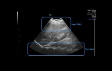Ultrasound image of liver and right kidney with near and far field marked.