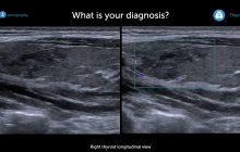 Ultrasound image of right thyroid longitudinal view.