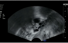 Ultrasound image of endometriosis.