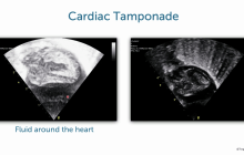 Cardiac Tamponade Thumbnail.