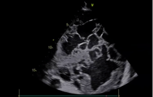 Ultrasound image of pathology that looks like spider webs.