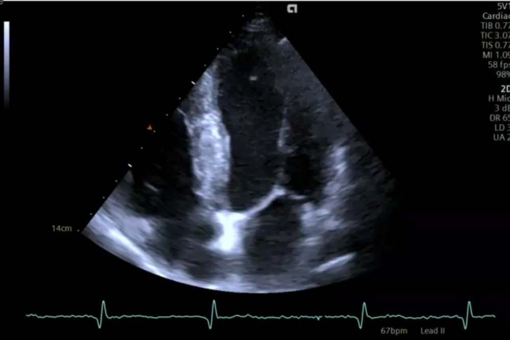 Common mistakes - Diastolic Dysfunction