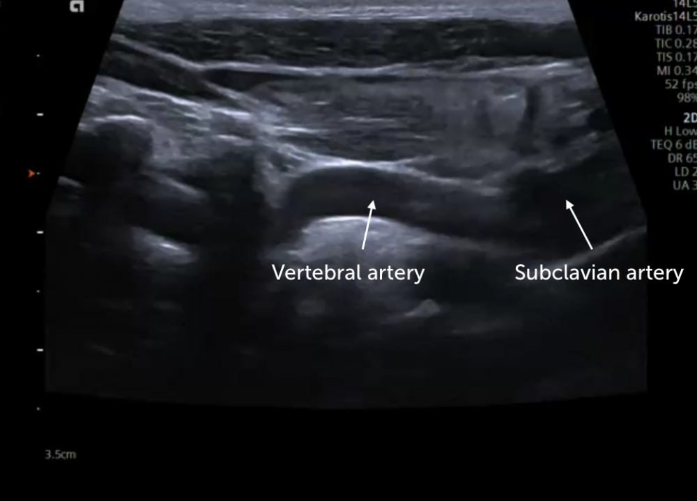 Vertebral artery dissection - Wikipedia