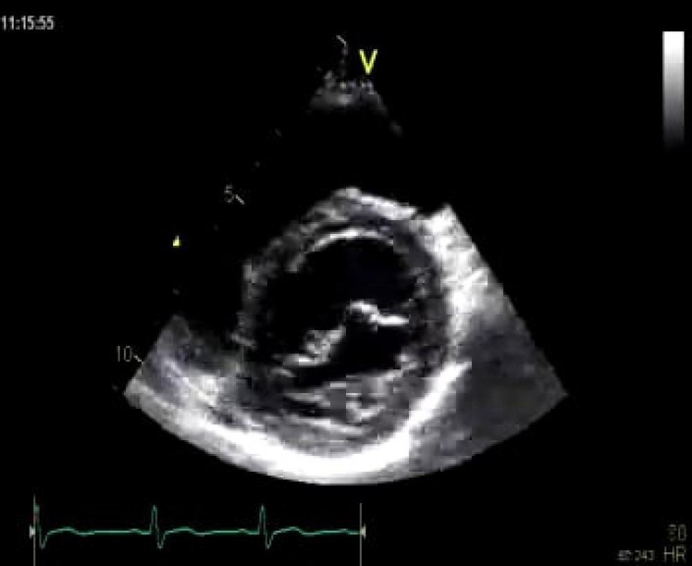 2-3-2-parasternal-short-axis-views-123sonography