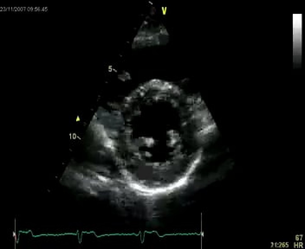 2 3 2 Parasternal Short Axis Views 123sonography