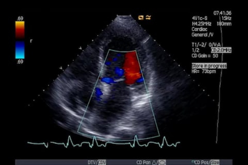 Ultrasound Doppler Principles Preparation Results And More