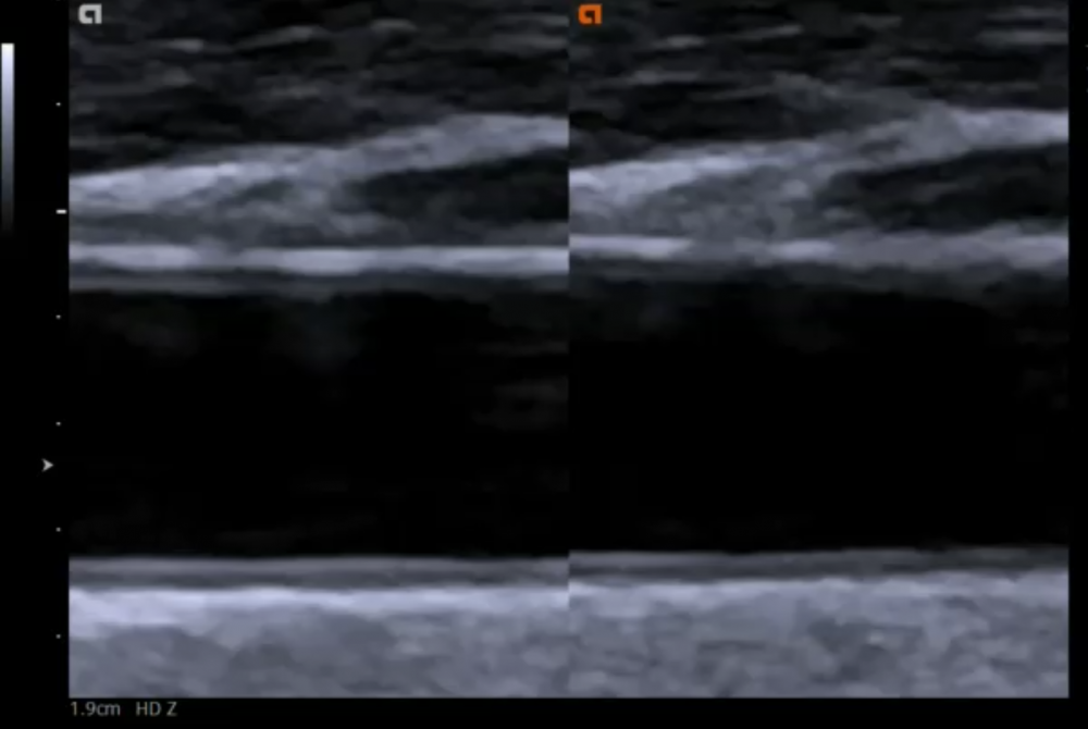 9. Assessment of intima media thickness (IMT)