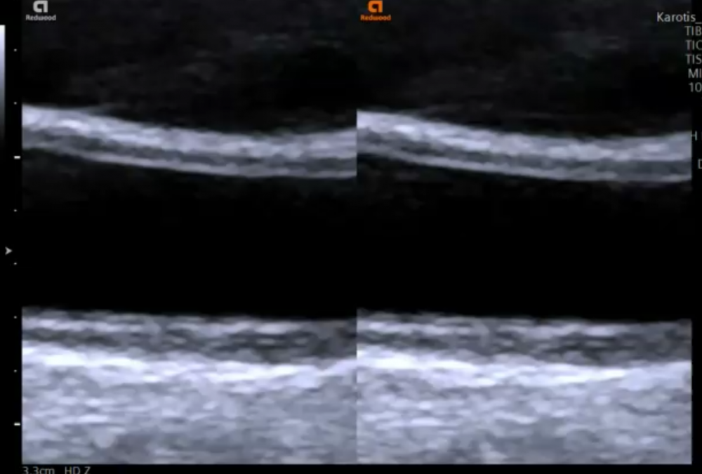 9. Assessment of intima media thickness (IMT)