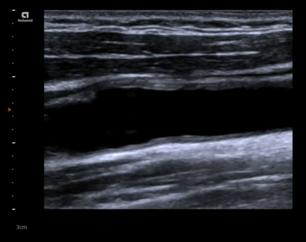 9. Assessment of intima media thickness (IMT)