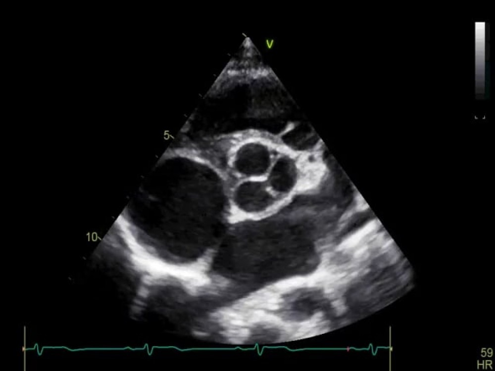 Parasternal Short Axis Basal View